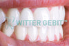 Veilig tanden bleken met deze methode